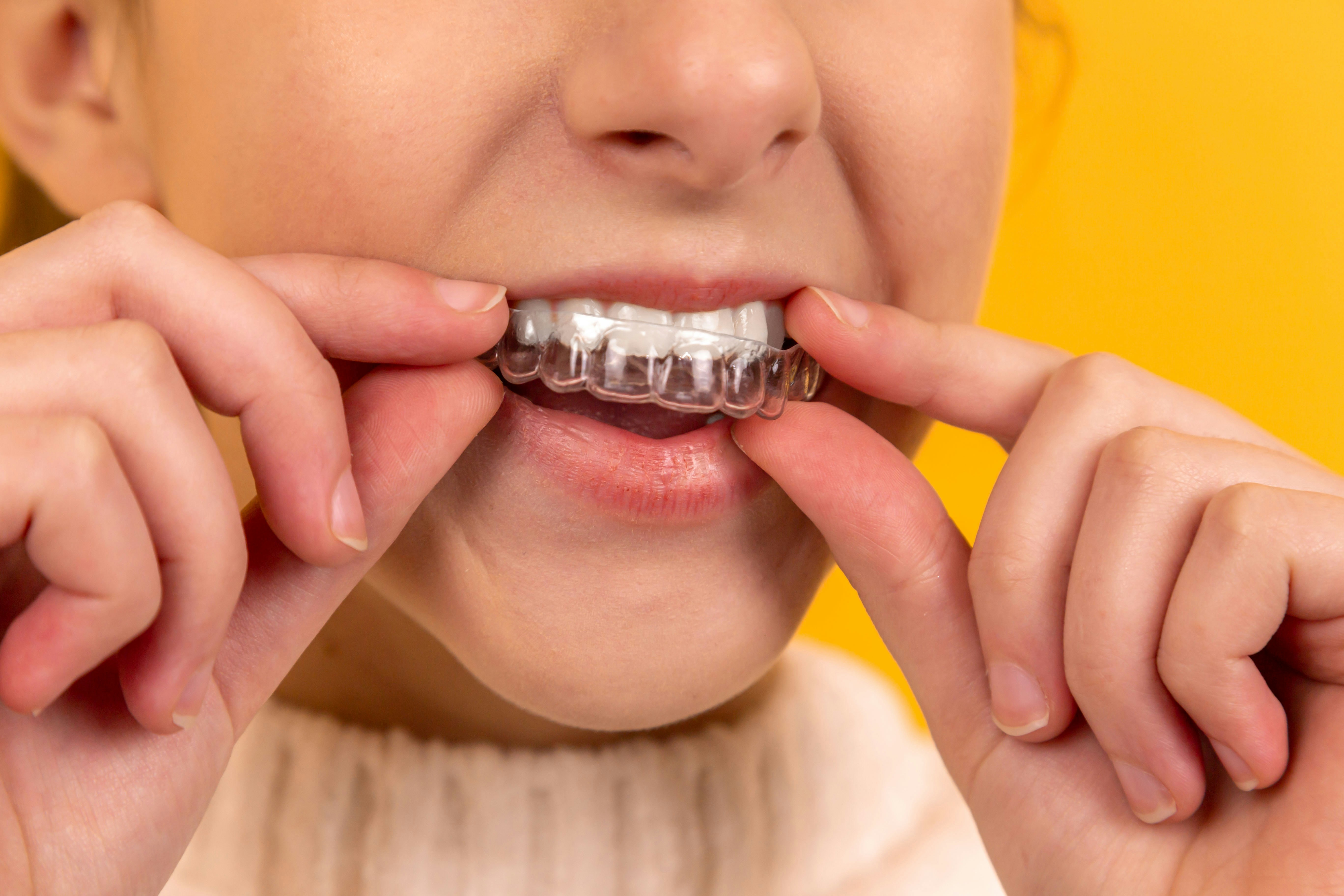 Modern clear-aligner care